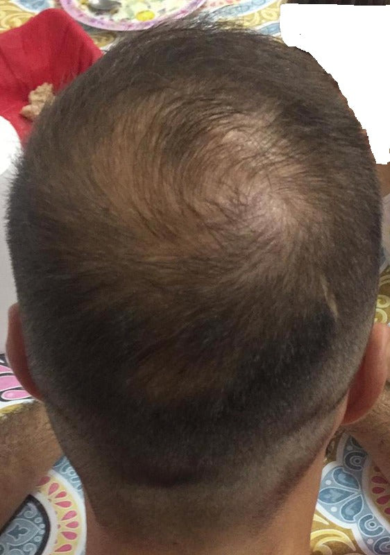 HAIR GROWTH PREVENT HAIR LOSS