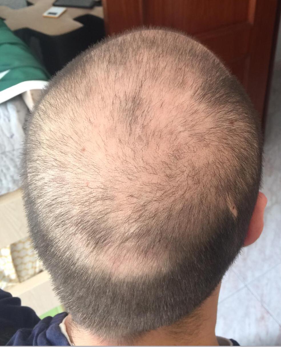HAIR GROWTH PREVENT HAIR LOSS